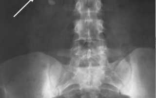 Уретрография (рентген уретры)